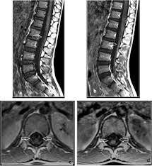 Sagittal and axial post contrast t1 fs images shows smooth thickening and abnormal enhancement of the cauda equina and the ventral nerve roots. Role Of Mri Evaluation In Acute Secondary Inability To Walk In Children Egyptian Journal Of Radiology And Nuclear Medicine Full Text
