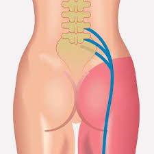 Image result for Sciatica