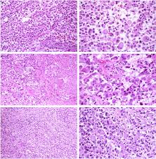 Exposure to asbestos is the most common cause of this disease, with the vast majority of cases occurring following exposures that may have taken place decades. Mesothelioma With Rhabdoid Features An Ultrastructural And Immunohistochemical Study Of 10 Cases Modern Pathology