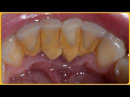 Toothpaste that gives you a healthy smile, with specialized solutions tailored to you. How To Remove Dental Plaque In 5 Minutes Naturally Without Going To The Dentist Youtube Remove Tartar Deep Teeth Cleaning Tartar Removal