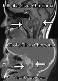 Virtualmedstudent Com Chordoma Radiology Imaging Medical Imaging Radiology