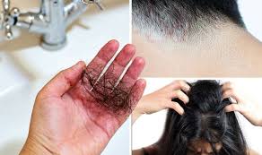 Introduction hair loss is characterized by abnormal hair cycles. Hair Loss Treatment Anti Fungal Medicine Cures Tinea Capitis Also Known As Scalp Ringworm News Chant Uk