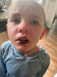 Anyone else had cracked lips after BMT?