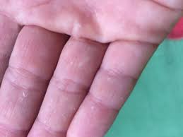 Blaschen In Der Handflache Und Den Fingern Gesundheit Und Medizin Haut Hand
