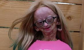 Adalia rose🌷 (@adaliarose06) on tiktok | 8.6m likes. Is Adalia Rose Alive A Closer Look At Adalia S Condition And Her Parents Thenetline