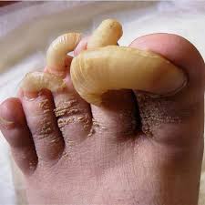 Image result for Onychogryphosis feet