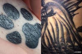 It is a healthcare caused lesion, due to entry of dental amalgam into the soft tissues. My Tattoo Looks Wrinkly Why And What To Do About It