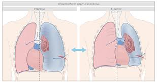 A pneumothorax happens when air enters the space between your rib cage and one of your lungs. Pneumothorax Amboss