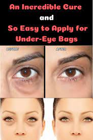 To keep things really simple: Women But Also Men Have Problems With Dark Under Eye Bags They Were Once So Pronounced That We Could Not Hide Them On A Rea Under Eye Bags Eye Bags Undereye