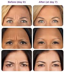 image result for botox injection sites chart botox botox