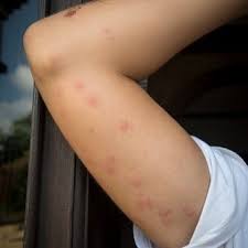 Image result for flea bites