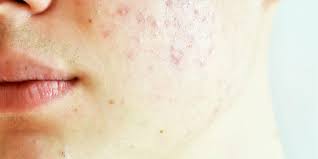 Berikut ini adalah obat herbal anti jerawat best seller yang ampuh untuk menghilangkan jerawat dan flek hita di wajah : 12 Cara Menghilangkan Bekas Jerawat Secara Alami Dan Medis