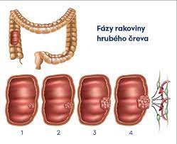 Check spelling or type a new query. Rakovina Hrubeho Creva Priznaky Diagnostika Prevencia Lekar Sk