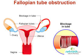 Sometimes polyps that grow in the uterus will have atypical endometrial hyperplasia. Fallopian Tube Cancer Causes Symptoms And Treatment