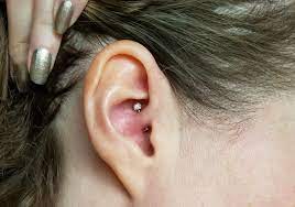 Migraine Piercing 1 Year Results After Daith Piercing For Headaches