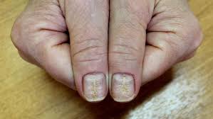 Loạn dưỡng móng là gì? Nguyên nhân, triệu chứng và cách điều trị là gì?  Nguyên nhân, triệu chứng và cách điều trị