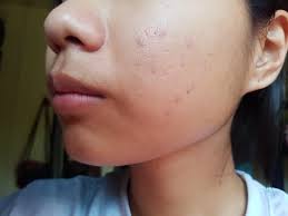 Using a different product every few days can also irritate your skin, causing new breakouts. Will Acne Scars Fade Over Time How Can I Remove Them I Also Have Them In My Forehead Acne