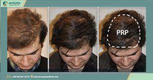prp البلازما للشعر كيف تعما لمنع تساقط الشعر وما النتائج المتوقعة منها وما هي الأعراض الجانبية
