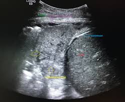 A video assisted thoracoscopic surgery (vats) with lysis of adhesions is also a viable option for loculated effusions. Lung Consolidation On Ultrasound Radiology Case Radiopaedia Org