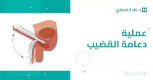 عملية دعامة القضيب أو دعامة العضو الذكري - عيادة الدكتور جاد الصمادي