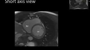 Image result for Cardiac MRI