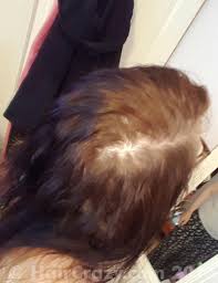 Have a look at how to use a hair colour remover to see the results of using colour remover on stubborn colours like special effects atomic pink as well as several manic panic and pravana colours. Uneven Hair Post Colour Remover What Next Forums Haircrazy Com