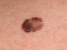 Learn about the academy's efforts to refocus its brand on education. Moles Atypical Moles Melanoma Mclean Woodbridge Virginia