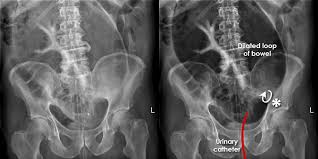 Image result for Sigmoid Volvulus