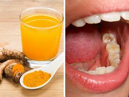 Terdapat banyak cara meredakan sakit gigi secara alami yang bisa dicoba, mulai dari menggunakan bawang putih, minyak cengkeh, hingga es batu. Petua Nak Cegah Hilangkan Sakit Gigi Berlubang Berkumur Dengan Air Kunyit Jer Cubalah Keluarga