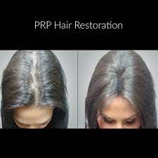 Prp Hair Restoration Hair Growhair Thinninghair Hairgrowth Hairloss Hairrestoration Prphair Prp Bet Prp Hair Vitamins For Hair Loss Hair Restoration