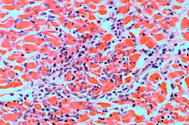 Symptoms can include shortness of breath, chest pain, decreased ability to exercise, and an irregular heartbeat. Cardiovascular Pathology