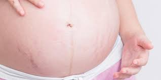 Kulit menjadi lebih gelap, kusam dan berjerawat. Stretch Mark Saat Hamil Penyebab Tahapan Dan Perawatan