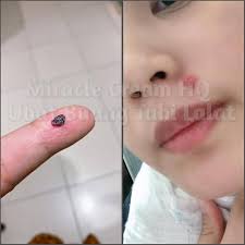 Berikut daftar pabrik farmasi/obat seluruh indonesia. Ubat Buang Tahi Lalat Home Facebook