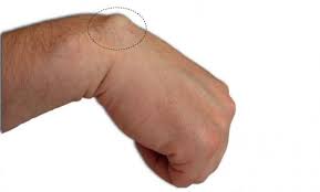 Le traitement préconisé pour soulager une ou des cheville(s) enflée(s) dépend de la enfin, les symptômes peuvent par ailleurs être soulagés au naturel, grâce à des plantes comme la vigne rouge ou le ginkgo biloba, qui s'avèrent particulièrement. Kyste Les Causes Les Symptomes Quels Traitements Naturels