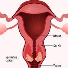 Agar terhindar dari risiko penyakit ini Ini Bedanya Kanker Serviks Dan Kanker Ovarium
