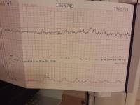 Dezelerationen, also verlangsamungen der herzfrequenz, werden synonym auch als dips bezeichnet. Ssw 33 Ctg Forum Schwangerschaft Urbia De