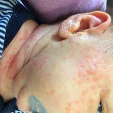 Cows milk (either in the mothers diet or engineered into formula) is a common source of food sensitivity in babies. Milk Protein Allergy In Babies Dairy Free Diet For Breastfeeding Veronika S Blushing