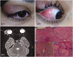 Image result for Dacryoadenitis