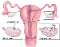 Polycystic ovarian syndrome is a hormonal condition associated with irregular menstrual cycles, excess hair growth, acne, reduced fertility, and increased risk of diabetes and mood changes. Polycystic Ovary Syndrome Harvard Health