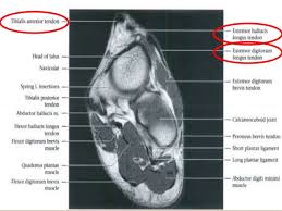 Mri with hardware in foot? Foot Radiological Anatomy Shorouk Zaki