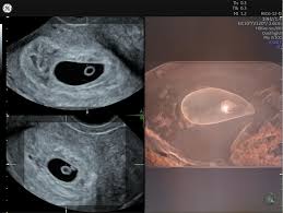 Image result for Ultrasound