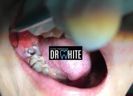 Cabut gigi geraham bongsu wisdom tooth removal. Cabut Gigi Bongsu Tak Klinik Pergigian Dr White Facebook