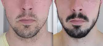 Starting off with a good mustache but weak cheeks, this man strengthened his beard from density to coverage. Good Or Bad Does Rogaine Really Help Grow A Beard