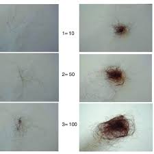 Unlike hair shedding, hair loss, or anagen effluvium, may not resolve itself naturally. Hair Shedding Scale Women Are Asked Which Image Best Corresponds To Download Scientific Diagram