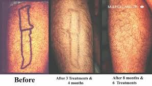 Tattoos are one of the most common forms of body modification. Laser Tattoo Removal Clinic Toronto See Our Before Afters