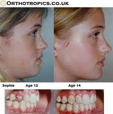 Case Study For Sophie 2 Plastic Surgery Fail Jaw Surgery Health Check