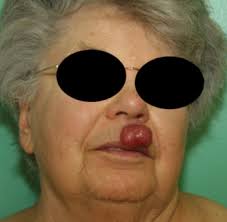 Carcinoma neuroendocrino cutáneo primitivo