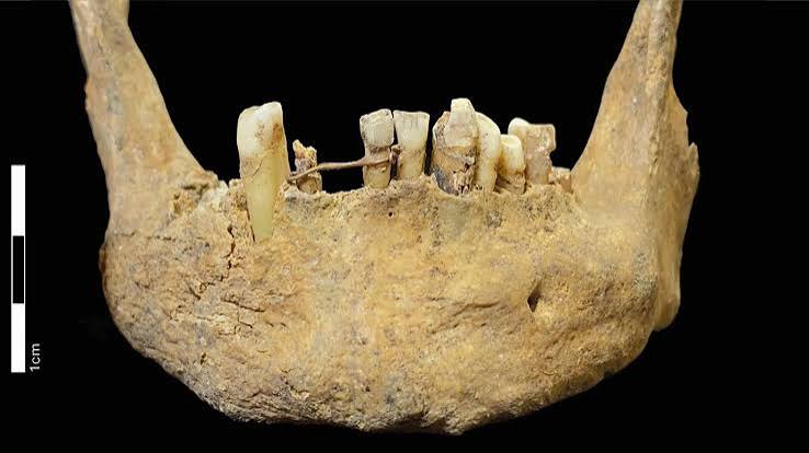 7-year-old Maya child had green jade 'tooth gem,' new study finds | Live Science