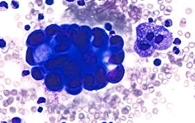 Pulmonary embolism (pe) is gradually considered to be the third most common disease in the vascular disease category. Egfr Positive Lung Cancer Diagnosis And Patient Quality Of Life Cancer Therapy Advisor