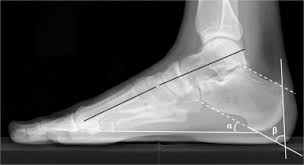 Haglund's syndrome is a cause of retrocalcaneal pain. Operative Treatment Of Haglund Syndrome With Central Achilles Tendon Splitting Approach The Journal Of Foot And Ankle Surgery